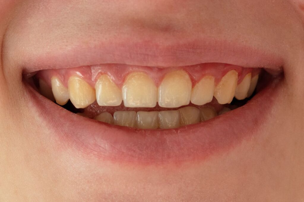 Sourire avec dents visibles