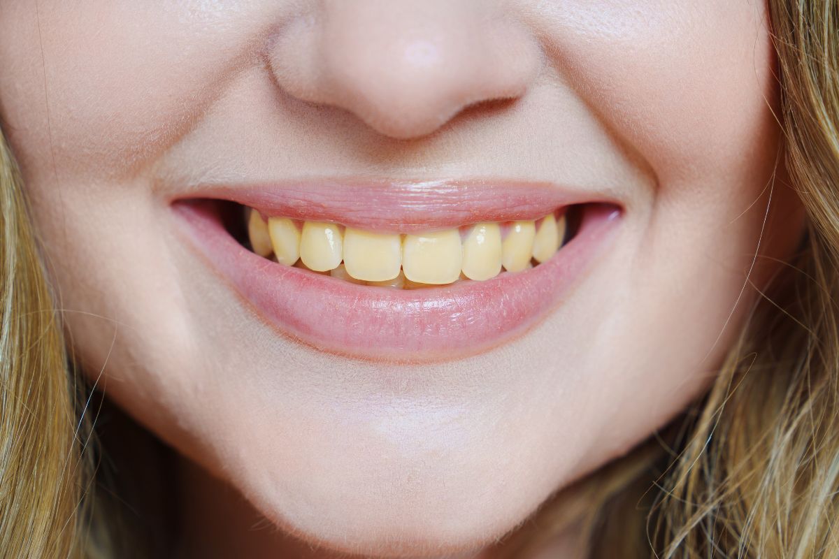 Sourire de femme avec dents légèrement jaunes.